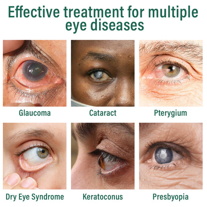 ✅Ourlyard® Nano Eye Drops Serum 👩‍⚕️Suitable for presbyopia, dry eye syndrome, glaucoma, and cataracts💦